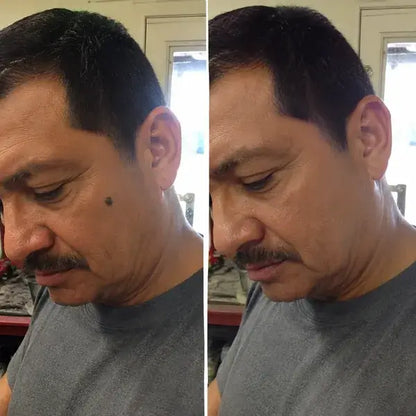 Erase Moles, Skin Tags & Spots in Just 7 Days