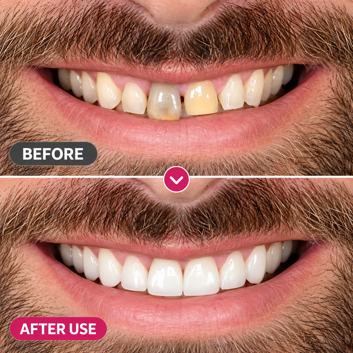 TopSpire™ DenPerm Cavity-Repair Natural Enamel Filling Gel
