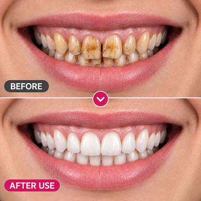 TopSpire™ DenPerm Cavity-Repair Natural Enamel Filling Gel