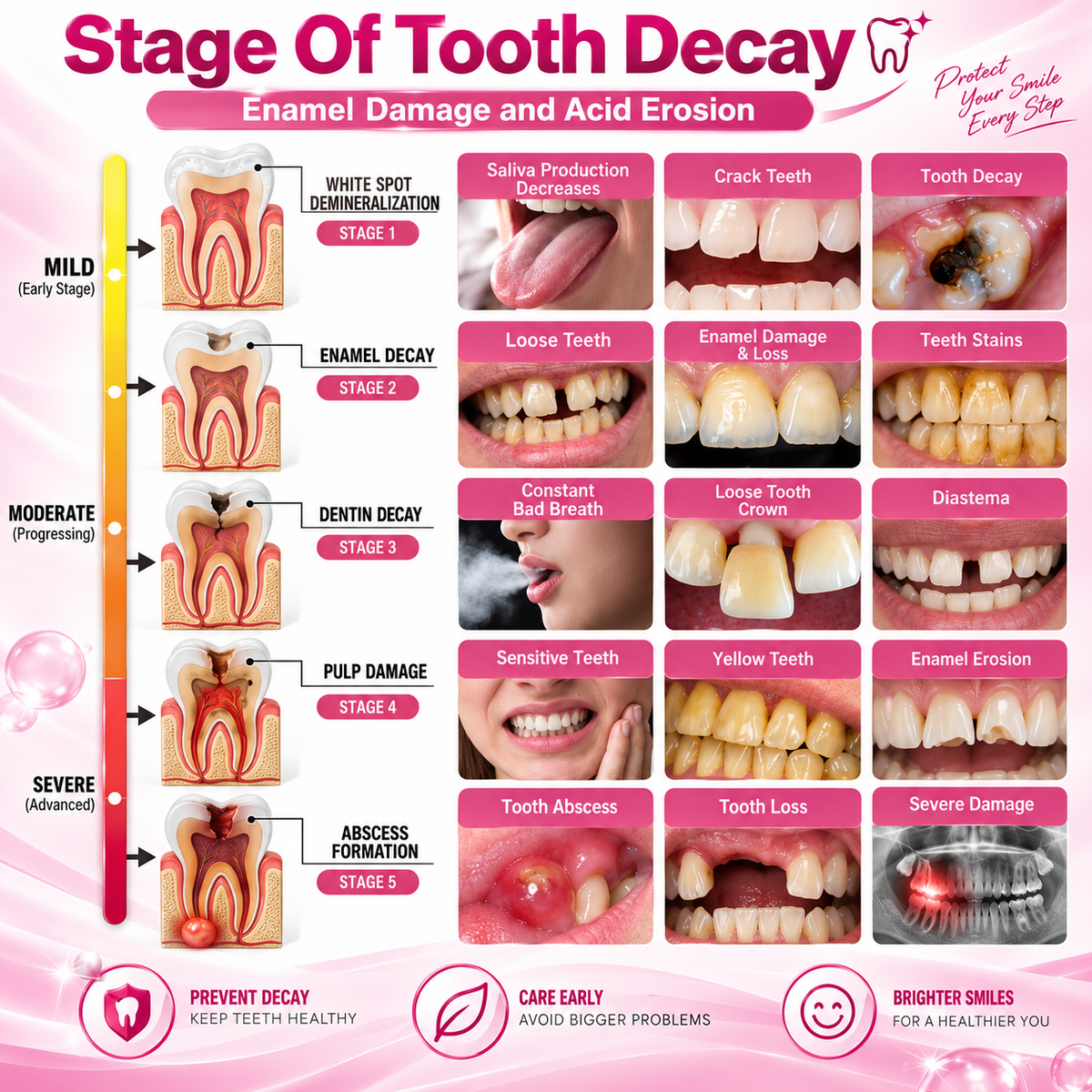 TopSpire™ DenPerm Cavity-Repair Natural Enamel Filling Gel