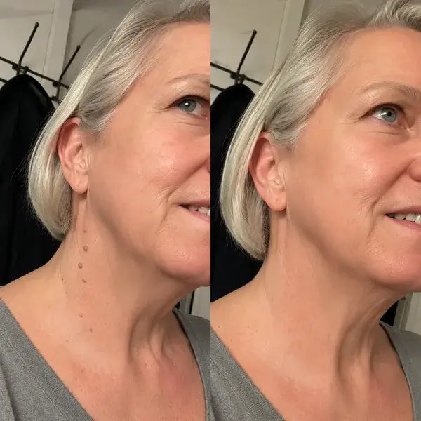 Erase Moles, Skin Tags & Spots in Just 7 Days
