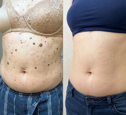 Erase Moles, Skin Tags & Spots in Just 7 Days