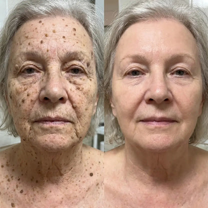 Erase Moles, Skin Tags & Spots in Just 7 Days